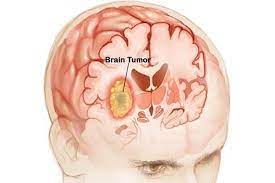 An in-Depth Review on Brain Cancer Symptoms