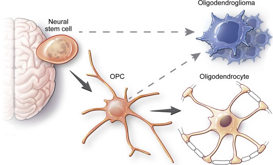 The Oligodendroglioma Brain Tumor Explained