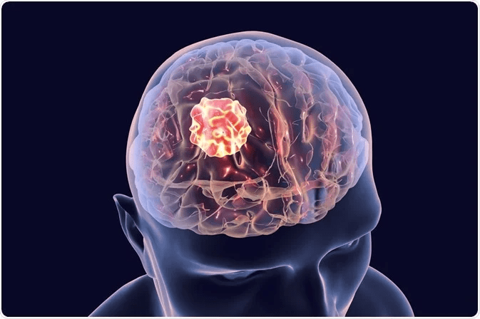 Early Signs and Symptoms of Brain Tumor!