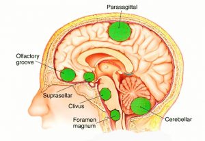 Types of Brain Tumors
