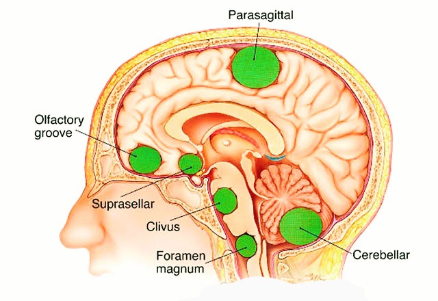Different Types of Brain Tumors