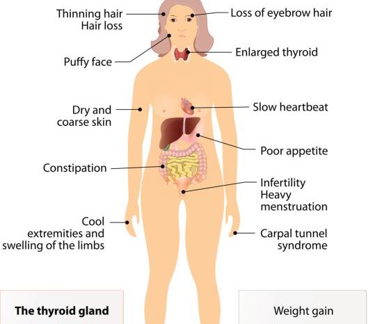 Do You Have Hypothyroidism and How Is It Caused?