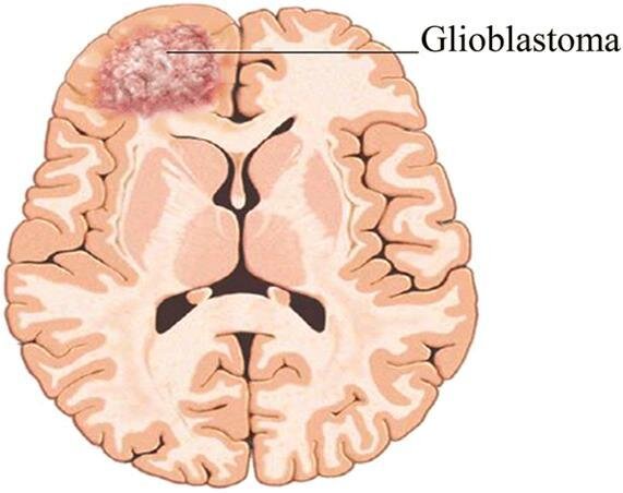Glioblastoma Multiforme Explained