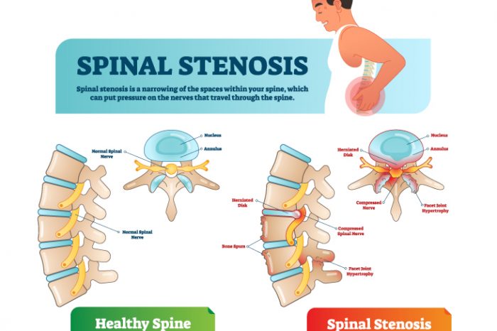 What Is Spinal Stenosis And What Pure Therapy Helps?