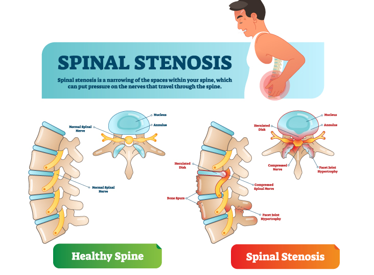What-is-Spinal-Stenosis