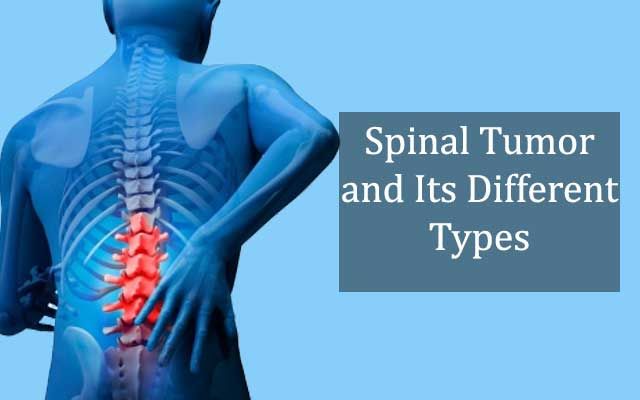 cancer Of Spinal Twine Tumors