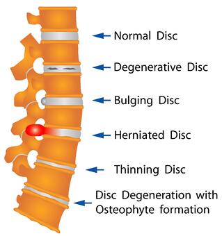 Herniated Disc Signs - What You Should Know Spine Health?