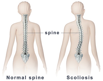 Scoliosis and Golf