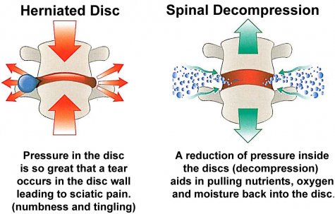 What Are the Contraindications for Spinal Decompression Therapy?