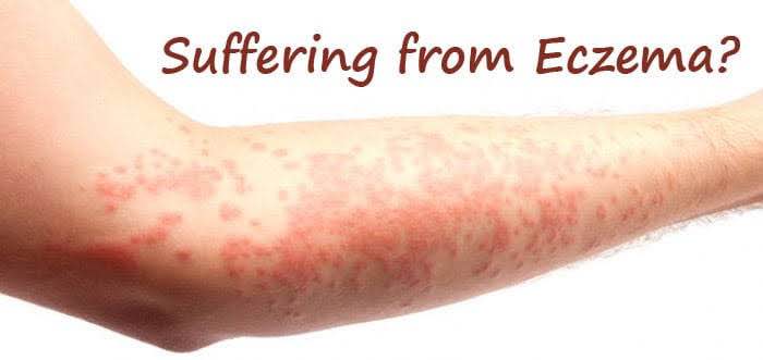 What You Ought to Learn About Chronic Eczema
