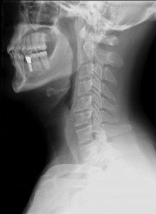 Cervical_Xray