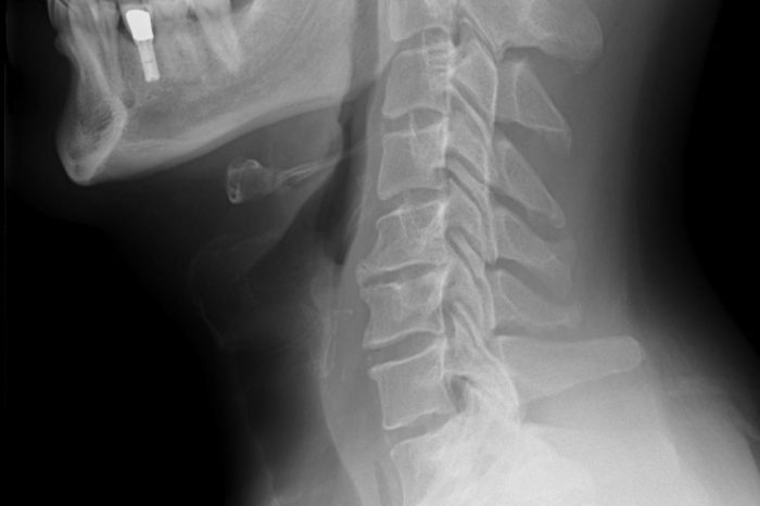 Cervical Spine x-ray
