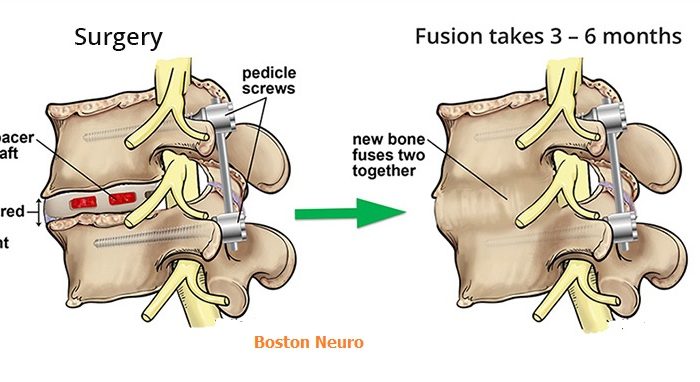 Why is Spinal Fusion Performed?