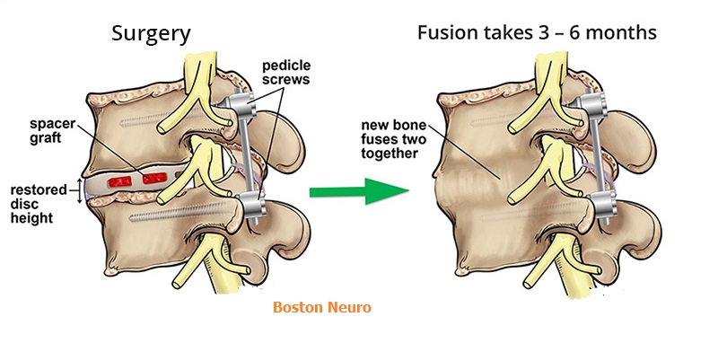 Why is Spinal Fusion Performed?