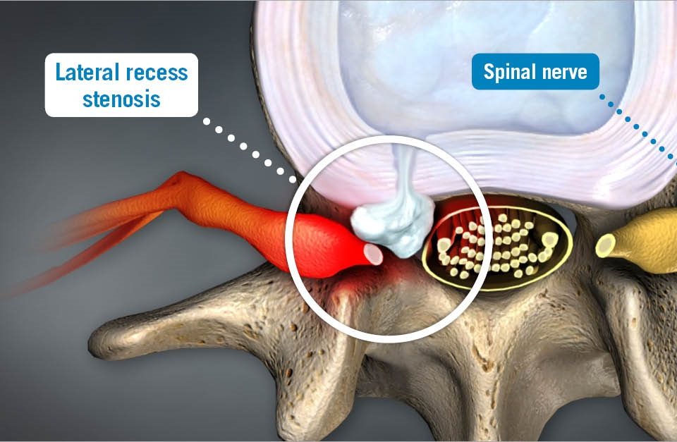 Lateral Recess Stenosis and Treatment