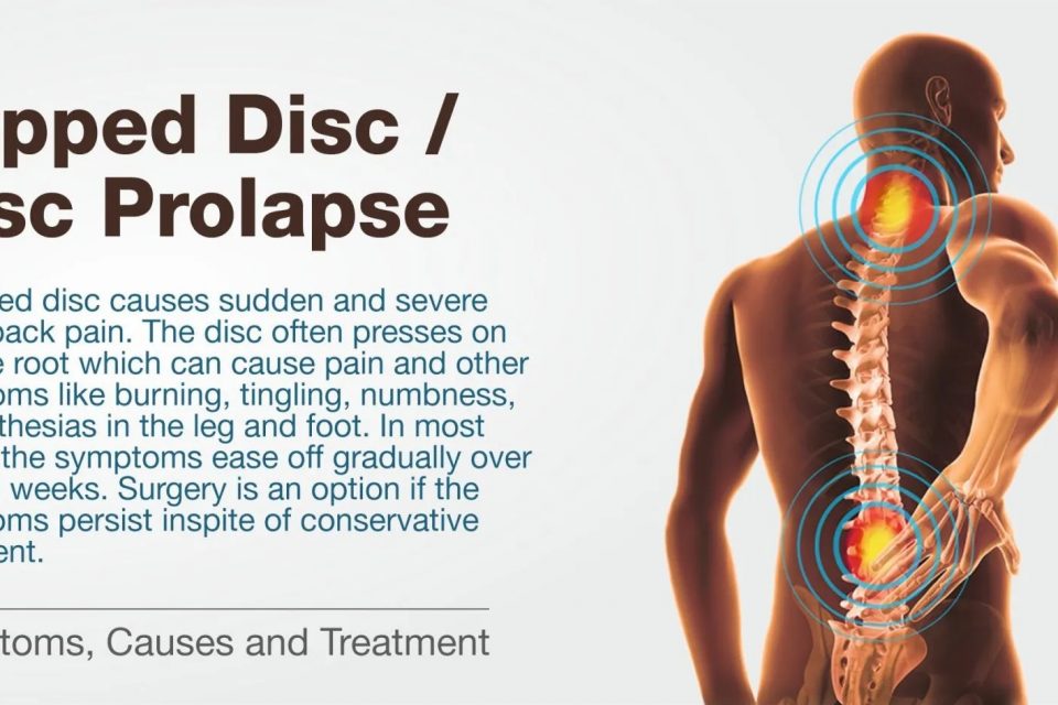 Slipped Disc Symptoms and Treatment