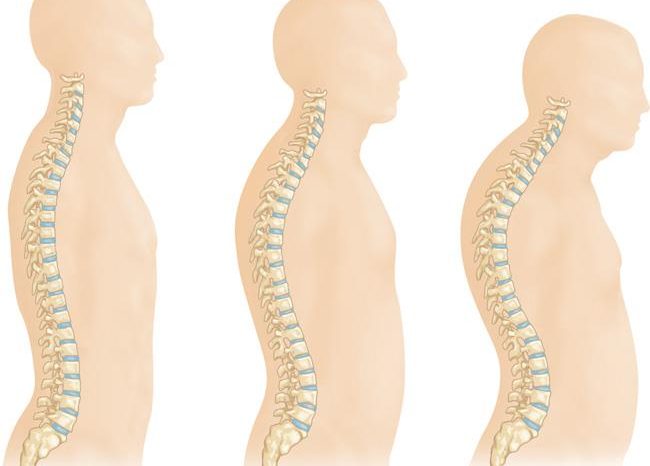 What causes Osteoporosis Fracture in the spine? Osteoporosis Vertebral Fractures